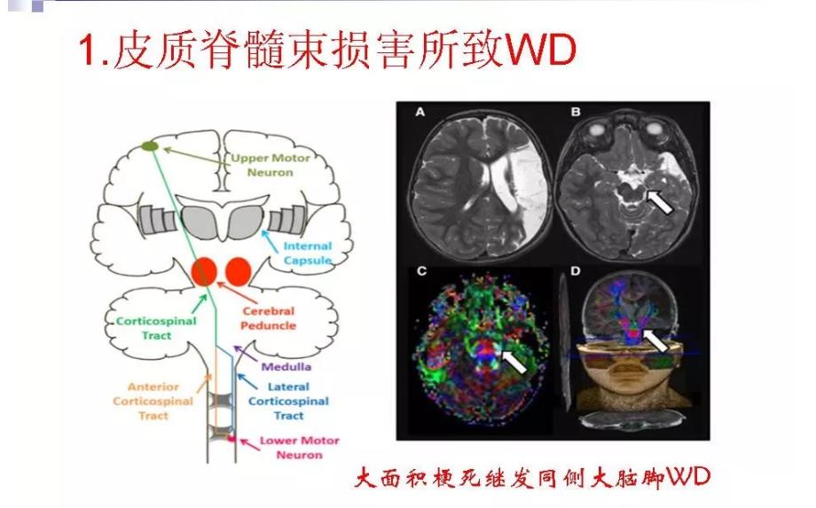 华勒氏变性图片