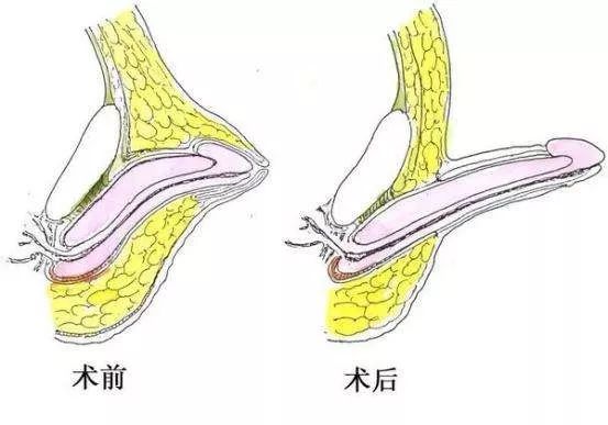 隐匿手术后长大后图片图片