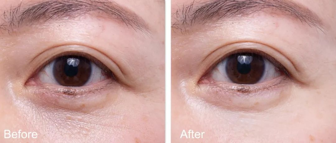 85年,眼下的真性初老纹