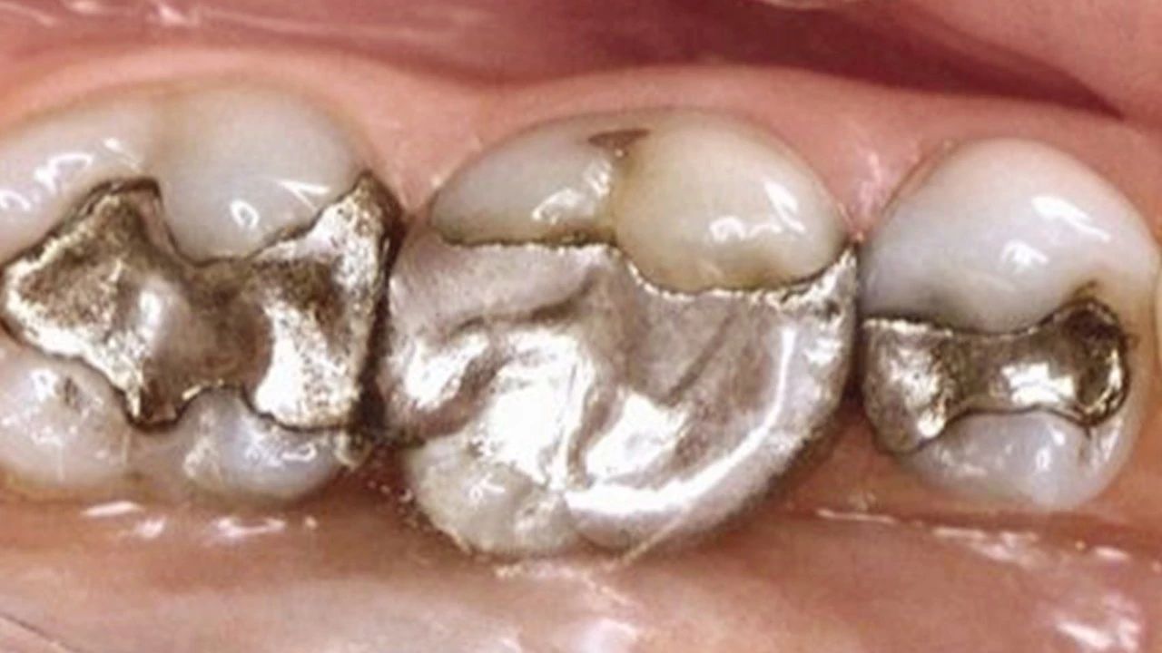 口腔超级科普火了150年的银汞合金逐渐消失在口腔的视野