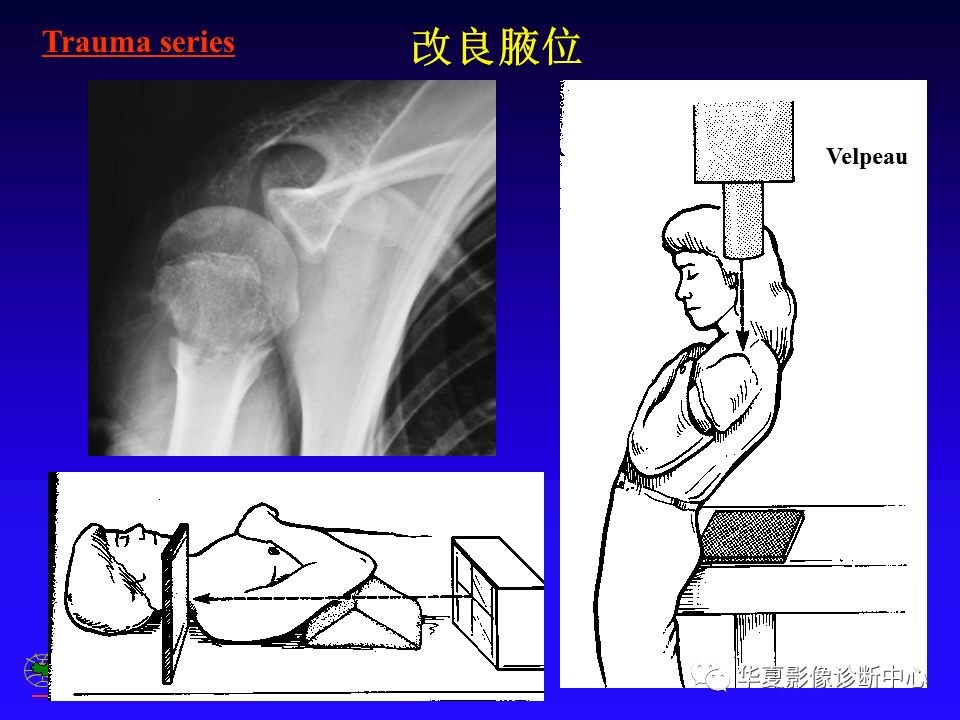 肩关节穿胸侧位图片