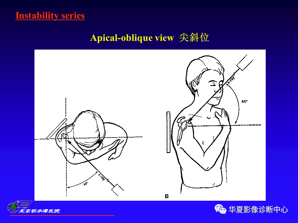 肩关节穿胸侧位图片