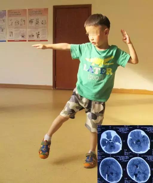 宝宝出生三个月患化脓性脑膜炎脑积水头围慢慢增大还能治好吗