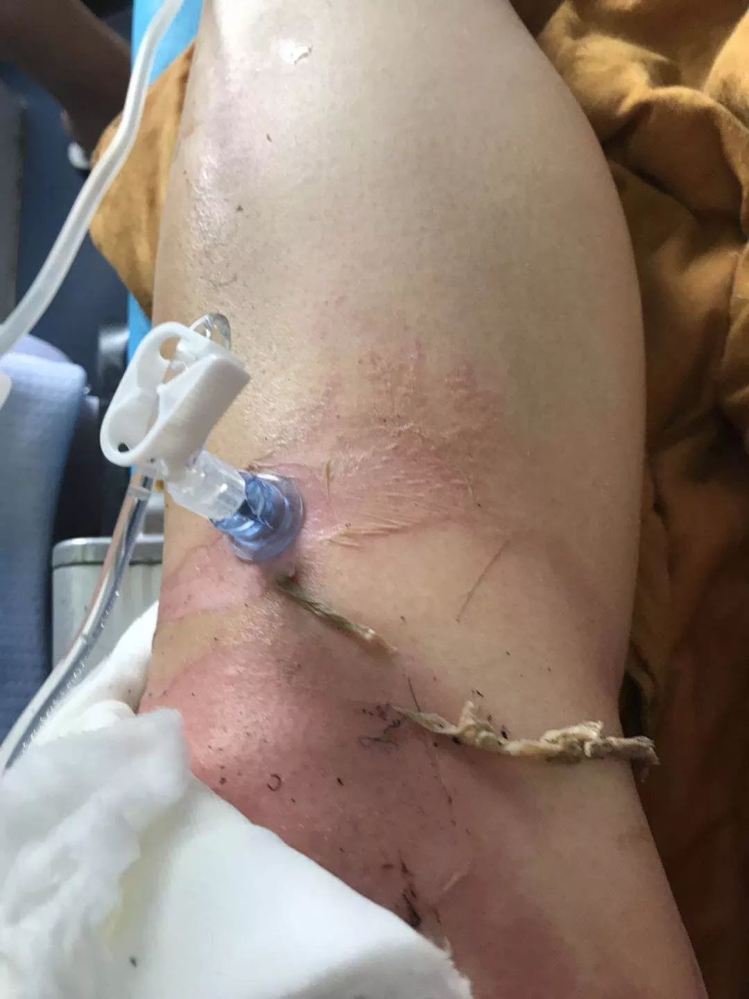 吃火锅酒精炉爆炸!全身60%烧伤,快救命!