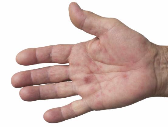 原创肝脏有癌手知道手上一旦出现3种症状肝癌可能离你不远了