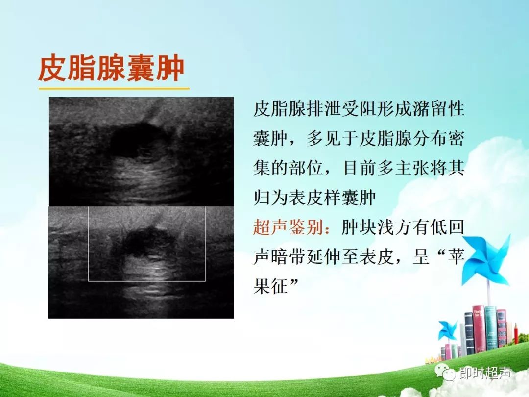 钙化上皮瘤超声图片图片