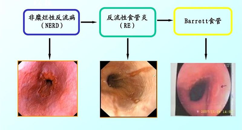 【醫學科普】警惕胃食管反流病