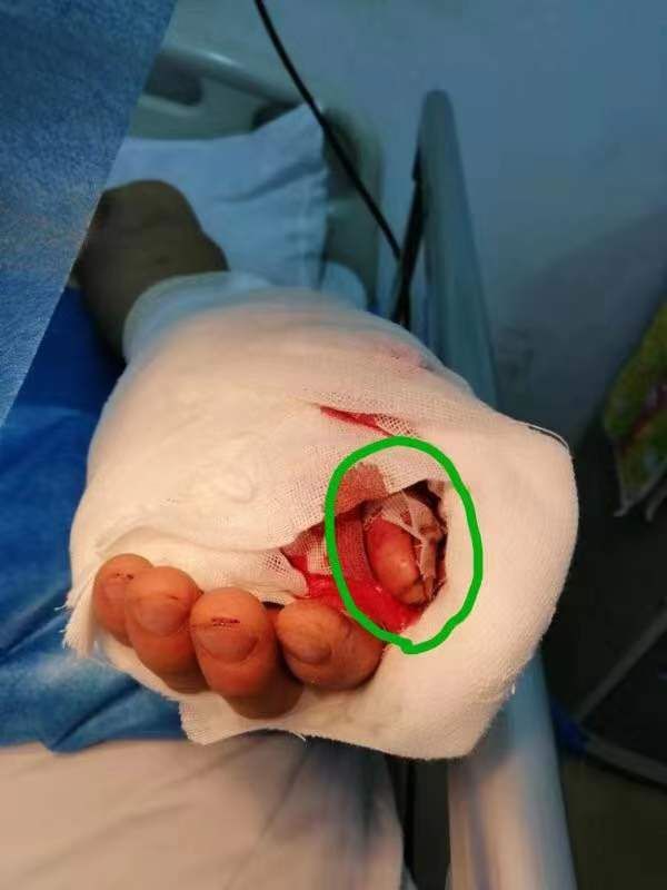 争分夺秒!交警紧急救助断指病人