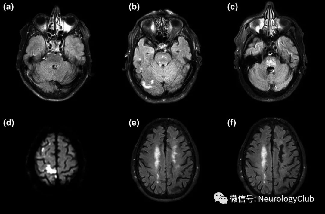 神经研究脑干白质疏松可独立预测缺血性卒中的不良预后