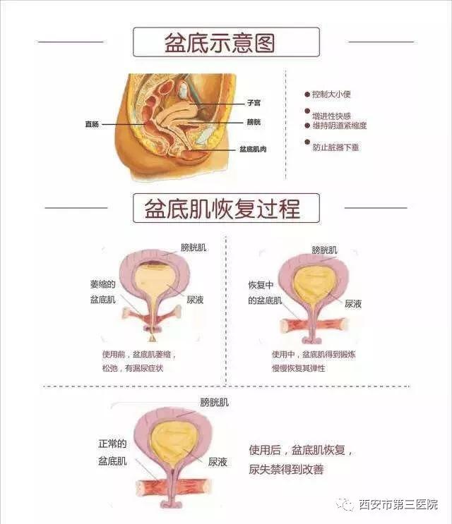 非手術治療主要有盆底肌肉電刺激療法,盆底生物反饋療法,盆底肌鍛鍊.