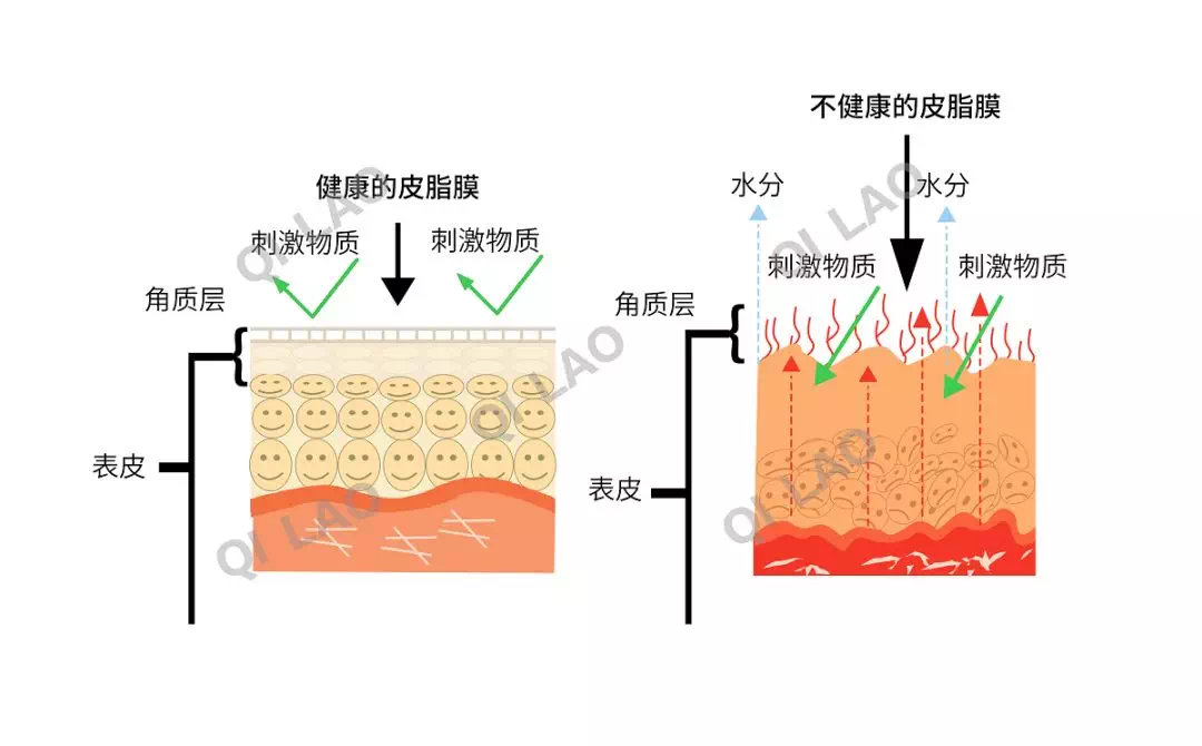 為什麼肌膚屏障受損了皮膚就會出現各種炎症以及皮膚問題?