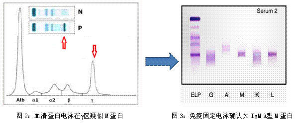 m蛋白检查(包括血清免疫球蛋白定量,血清蛋白电泳,血清免疫球蛋白轻链