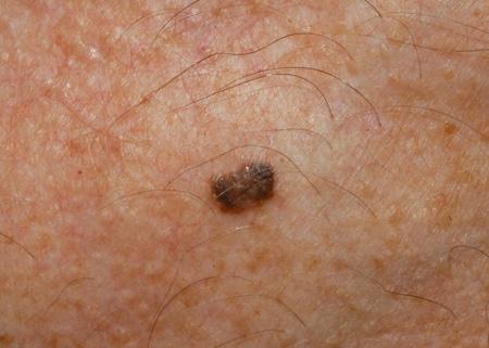和肝癌相关的皮肤表现你知道吗这五种皮肤问题要引起注意