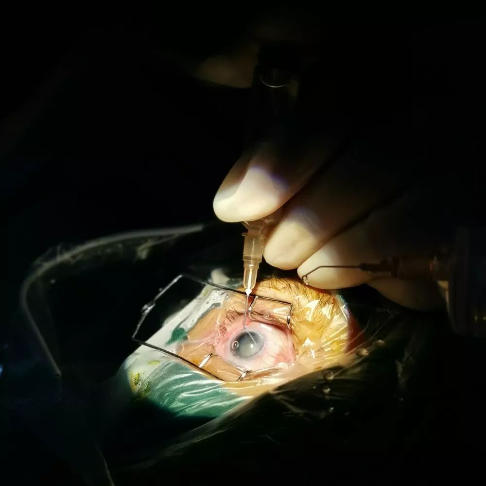 玻璃体植入手术图片