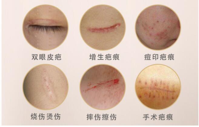 巴复平祛疤膏:关于祛疤你需要知道这些