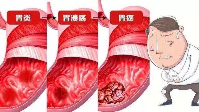 胃溃疡4大夺命并发症千万别大意