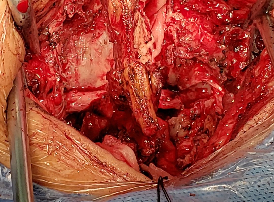 关靖宇教授脑卒中偏瘫手术治疗又有新突破健侧颈7神经