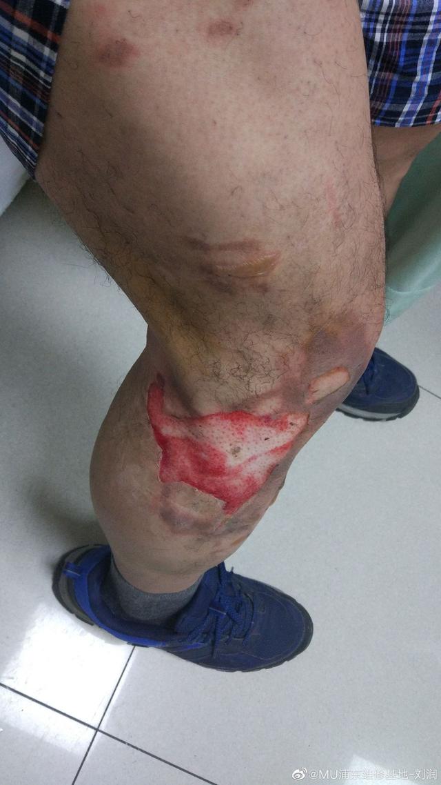 原创小米max手机发生爆炸造成用户二度烧伤