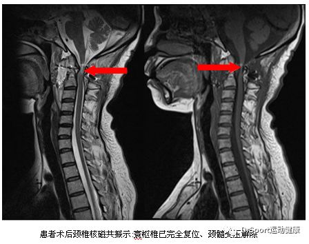 康复科普│由一个喷嚏引发的系列惨案寰枢椎半脱位