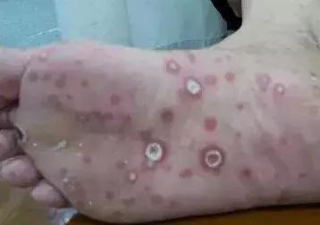 目前,刘老伯全身的红斑和糜烂处均有大量的梅毒病原体,传染性非常强