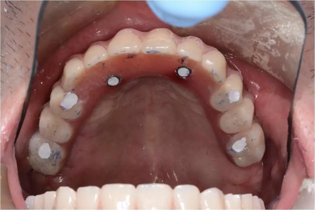数据匹配,模拟植体植入△制作临时义齿及放射导板案例具体操作如下