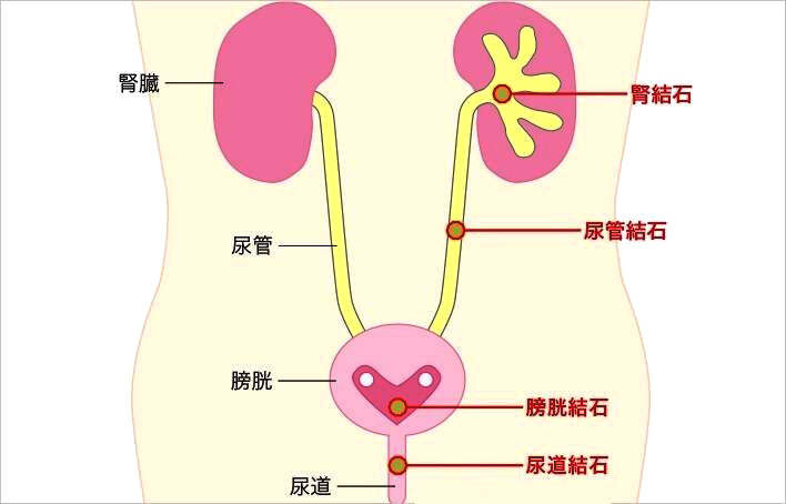 尿结石的正确跳姿图片