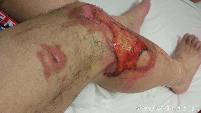 原创小米max手机发生爆炸造成用户二度烧伤