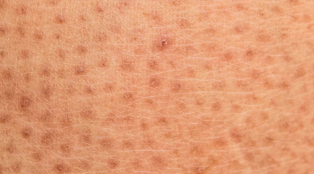 改善皮肤干燥起皮小疙瘩记住2个小技巧就够了