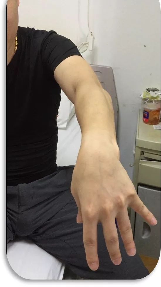 2019isprm学术报道肉毒毒素改善手部震颤伴痛性强直痉挛病例报道1例