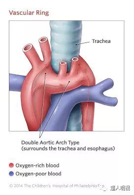 通俗谈谈胎儿血管环vascularring