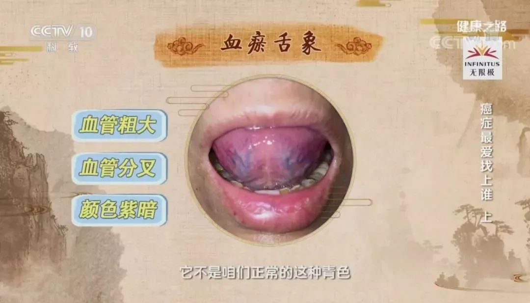 ① 舌头:舌下出现血管粗大,血管分叉,颜色暗紫的状态时,可能是血瘀