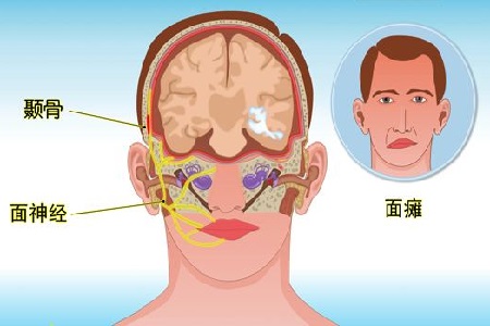 預防耳源性面癱就要從預防中耳炎的發生發展做起.