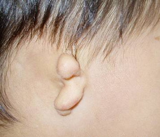 先天性小耳畸形患者的耳道是被"堵"上了吗?