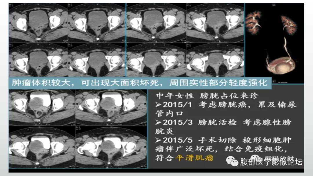 膀胱腫瘤影像表現小結