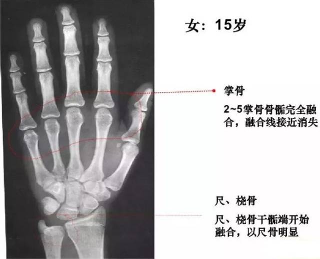 做了骨龄检查后,李医生看了骨龄片,摇摇头告诉女孩家长:骨龄已经15岁