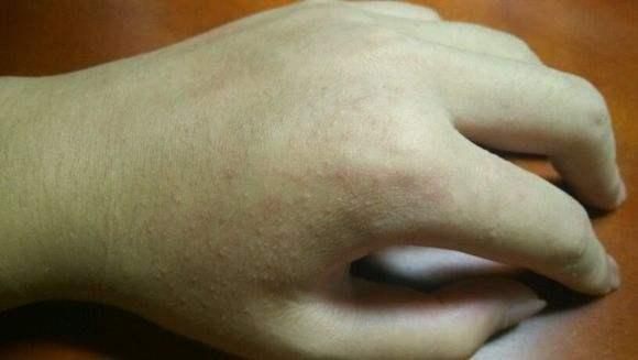 给宝宝防治痱子四大误区月嫂小心也中招