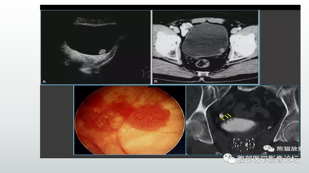 膀胱肿瘤影像表现小结_症状