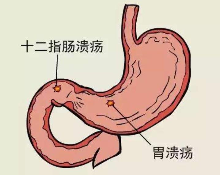 雨林君健康来谈,你认为口腔溃疡仅仅只是口腔的溃疡吗?_部位