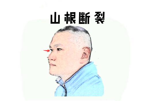 山根折断图片图片