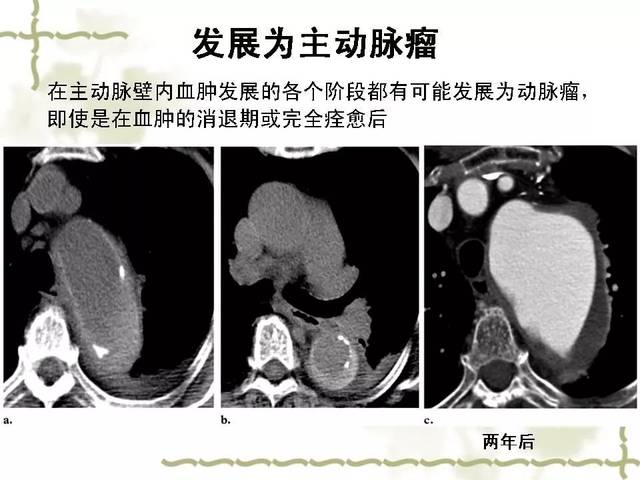 主动脉壁内血肿演变及ct表现影像天地