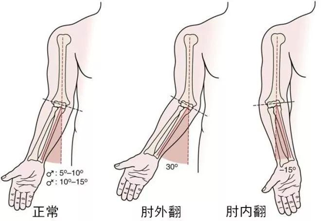 胳膊肘外翻怎么矫正图片