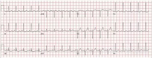 p 波电轴和形态正常;心率 100～180 次/分;p 波的幅度常增高,pr 间期