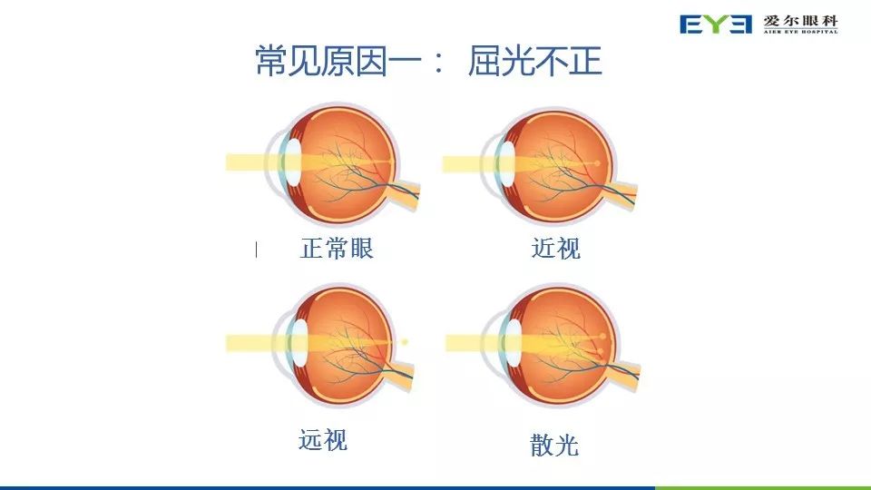 屈光不正看到的图像图片