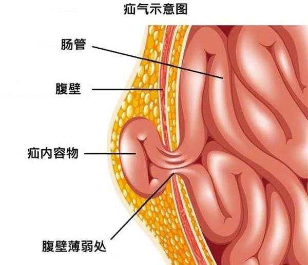 腹股沟位置图图片