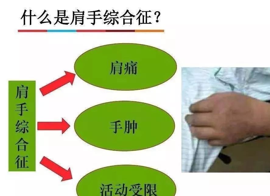 肩手综合征主要表现为患者患侧肘,肩,手指疼痛,手指僵硬,多汗,皮肤
