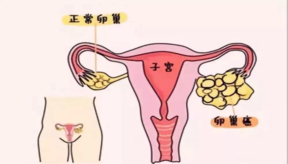 痛!痛!痛!痛!明明没有来月经,为什么肚子还会痛?