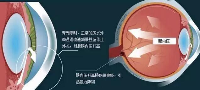 神奇青光眼手术,居然不用"刀"!_治疗