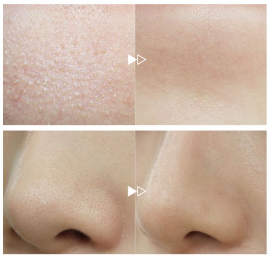 10分钟搞定闭口黑头这款清洁面膜我能回购10000年