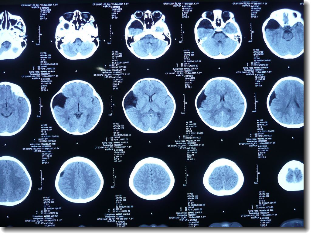 脑囊肿ct图片图片