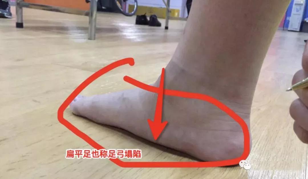 下自己的或者家人的足底情况)我们以abc的三弓三点来表示稳定支撑模式